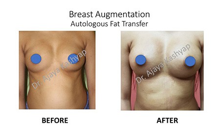 breast augmentation fat transfer in Delhi