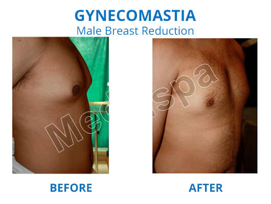 best gynecomastia india