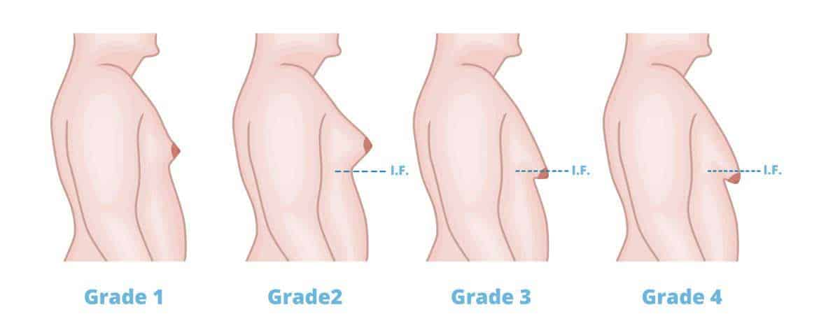 gynecomastia grades