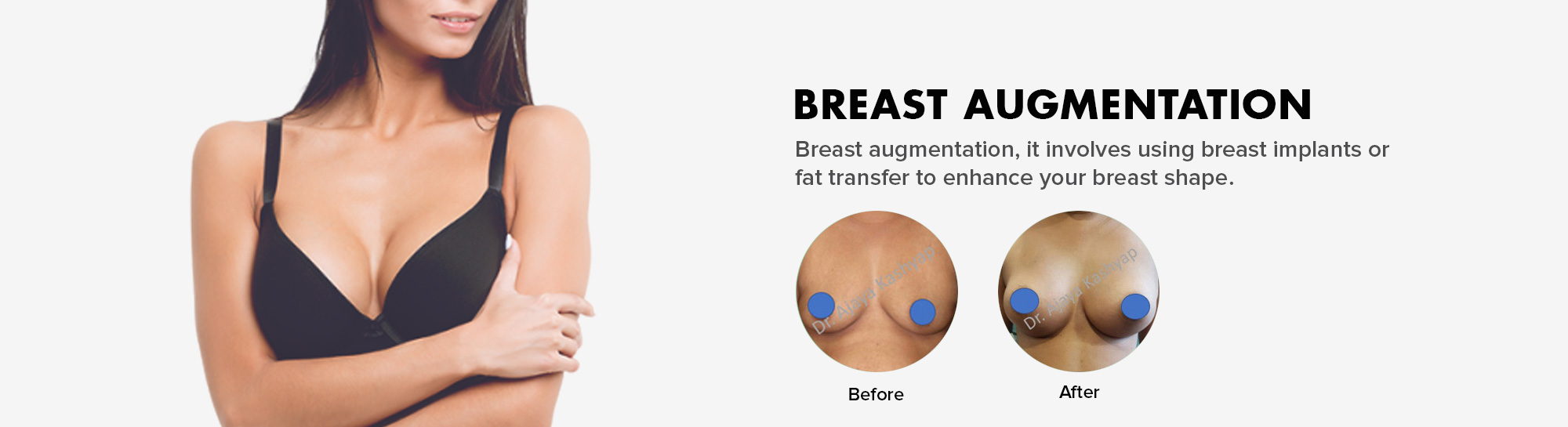 Breast Reduction in Delhi – Surgery Procedure for Smaller Breasts